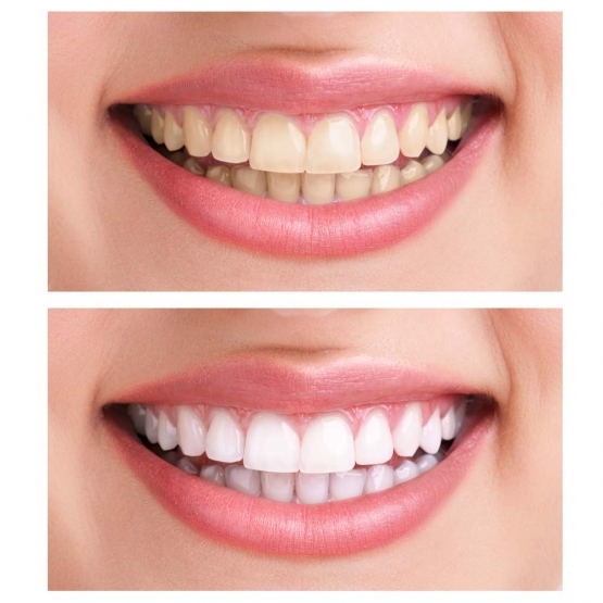 Čierne uhlie na bielenie zubov Čierne uhlie na bielenie zubov