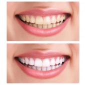 Čierne uhlie na bielenie zubov Čierne uhlie na bielenie zubov